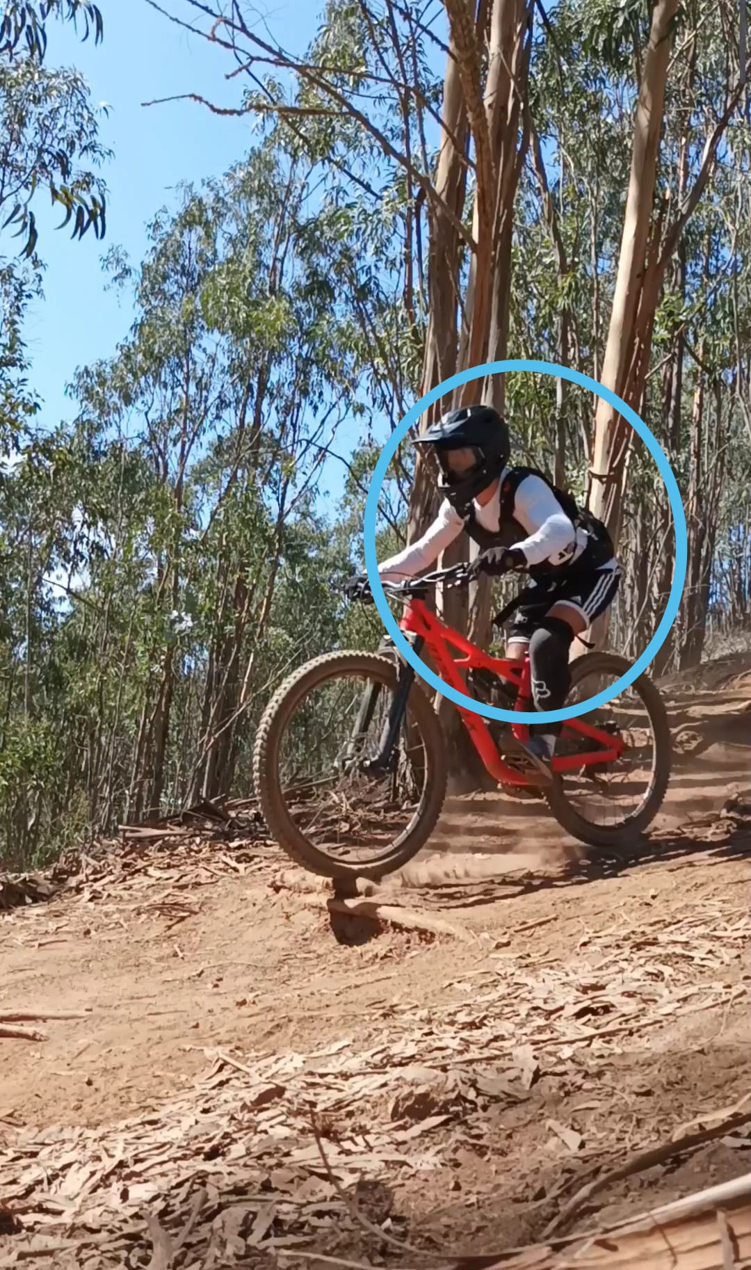 Retroversión de la cadera